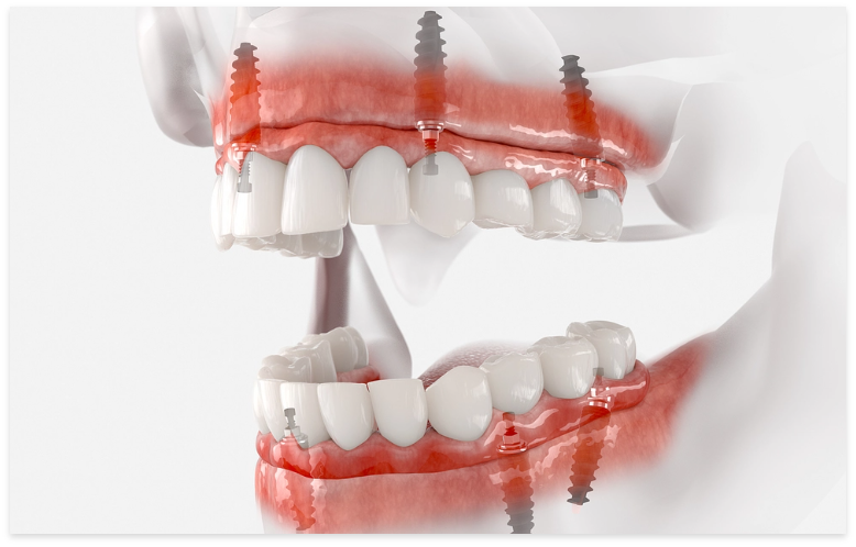 Full-Arch-Dental-Implants