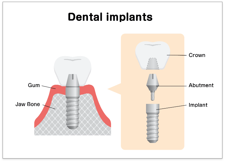 How-Dental-Implants-Work