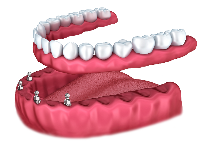 Implant-Supported-Dentures