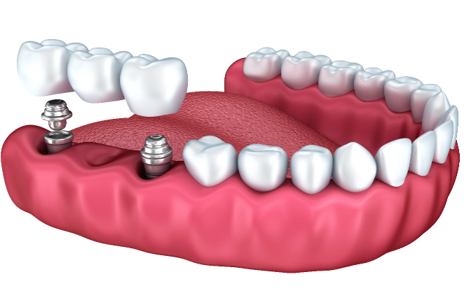 Replacing-Missing-Teeth